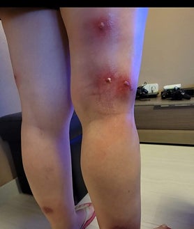 Imagen secundaria 2 - Vecinos con las consecuencias de la presencia de la mosca negra en sus barrios