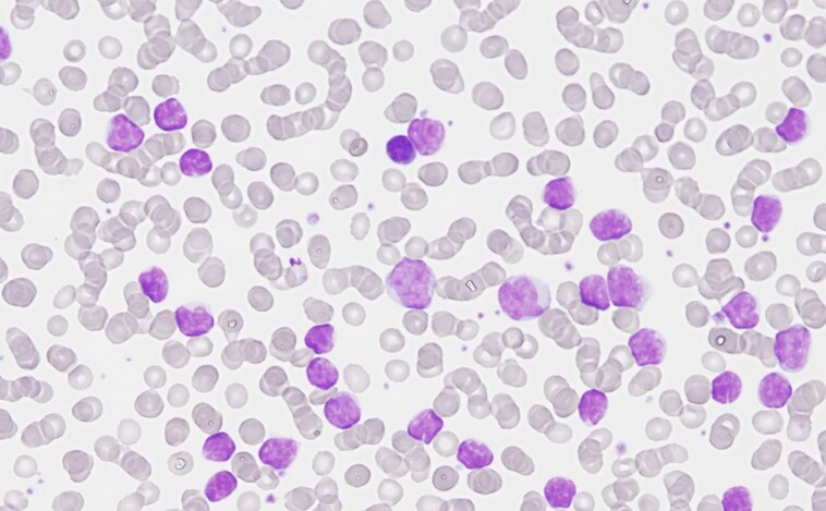 Completado el primer mapa genómico de la leucemia más común