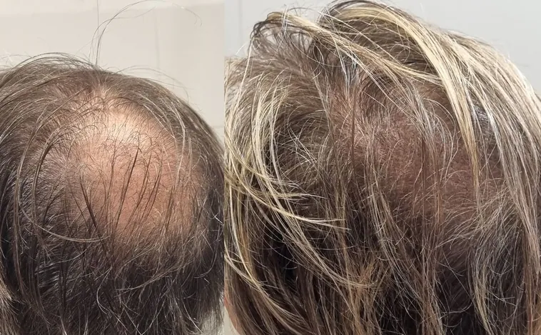 Tatuajes con efecto pelo: la novedosa alternativa al injerto para combatir la alopecia