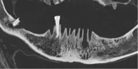 Muestra de la mandíbula con el colmillo inferior derecho y lesiones características de los abscesos odontógenos