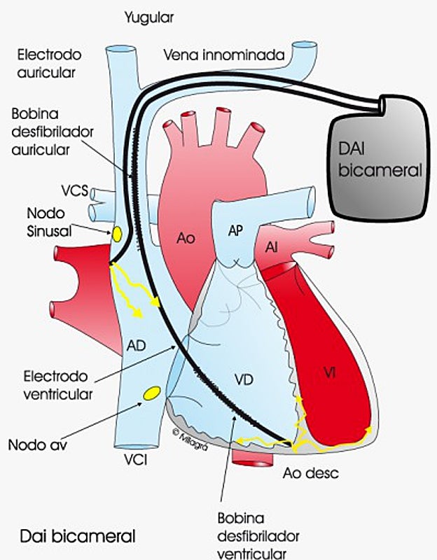 Imagen descriptiva de un corazón con un desfibrilador automático
