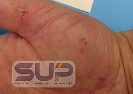 Imagen secundaria 1 - Uno de los agentes recibió una dentellada en la cabeza; también sufrió heridas en la mano y en el codo. Otro presenta una mordedura en la pierna derecha y erosiones. El tercero continúa de baja como sus compañeros