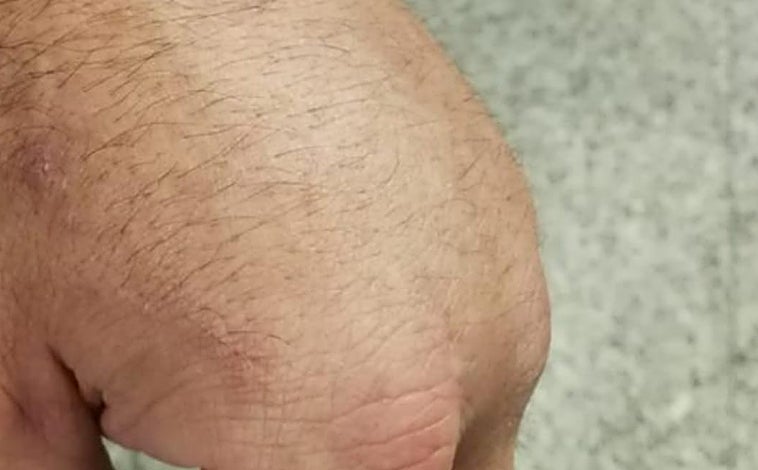 Imagen - Contusiones sufridas por el agente que impidió que el alto cargo escapara de las dependencias