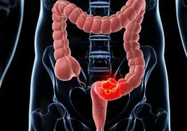 Cáncer de colon | Cirugía y 'quimio' a la vez: la clave para sortear que reaparezca a enfermedad