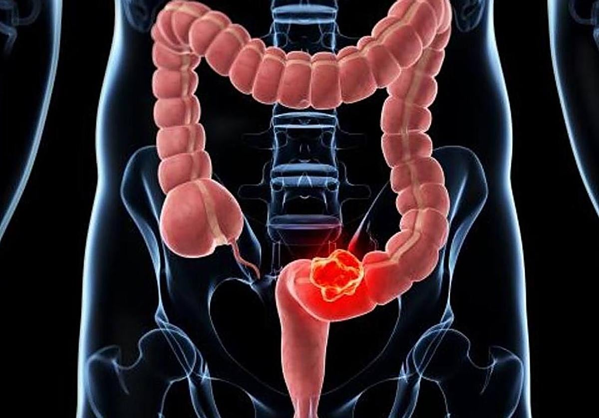 Cáncer de colon | Cirugía y &#039;quimio&#039; a la vez: la clave para sortear que reaparezca a enfermedad