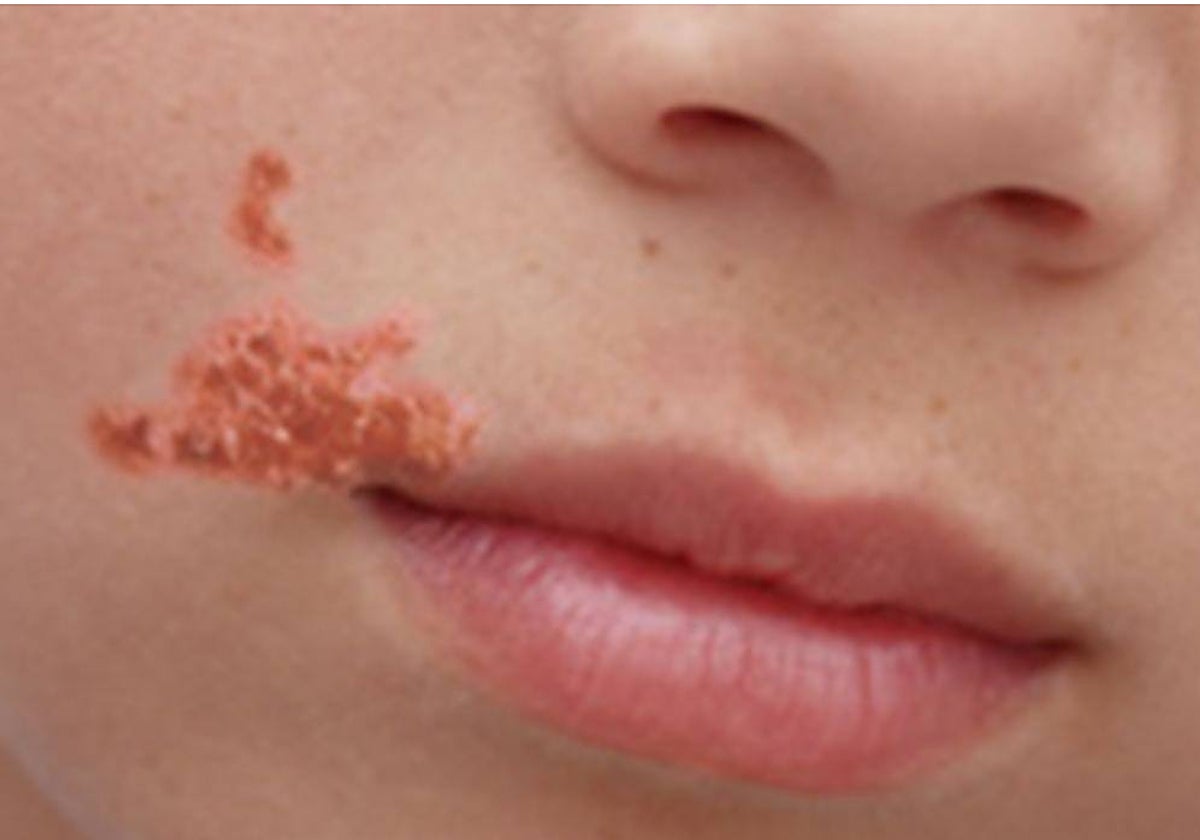 Imagen de archivo de un niño contagiado de impétigo