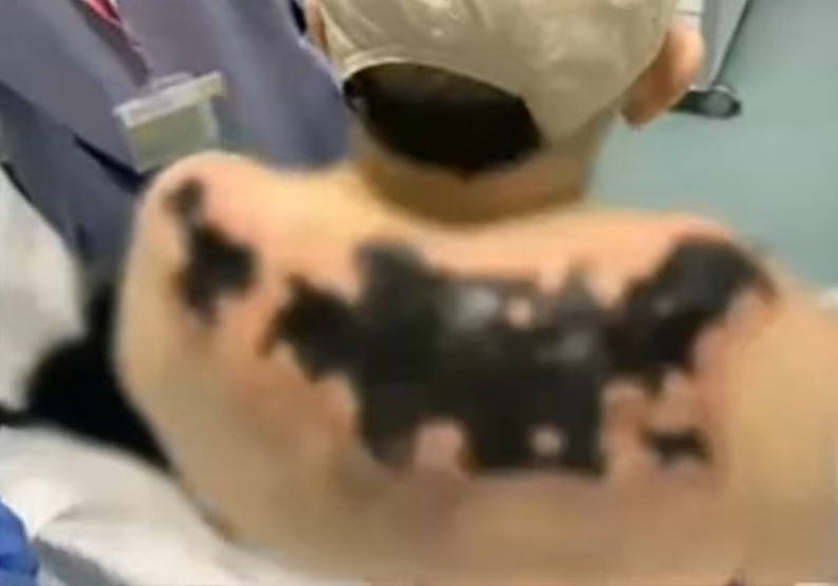 Detalle de las quemaduras sufridas por el anciano difundidas por la familia en las redes sociales