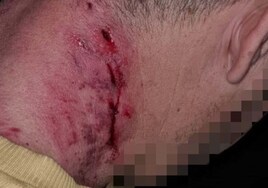 Un viandante, atacado brutalmente por un perro de raza peligrosa en Jaén