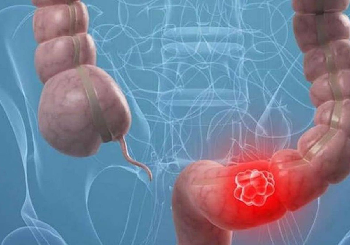 Castilla y León amplía a los 74 años el cribado de cáncer colonorrectal