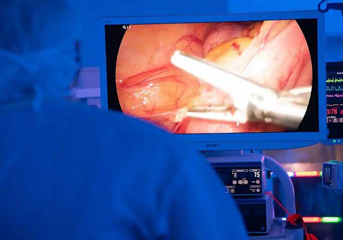 El riesgo de cáncer de colon cae un 60% tras el primer control de cribado