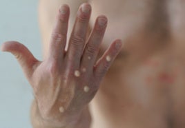 La Junta de Andalucía aísla a dos personas en Lepe hasta confirmar si padecen viruela del mono