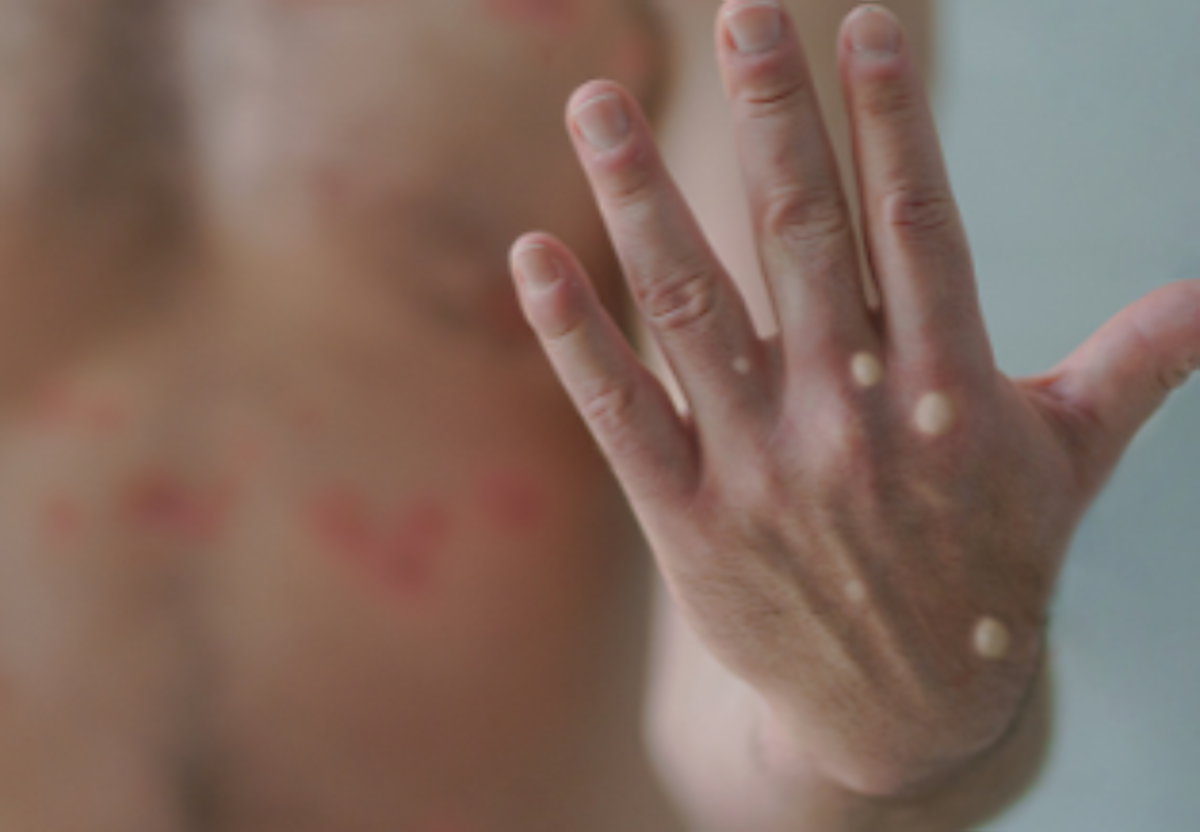 Un paciente con viruela del mono