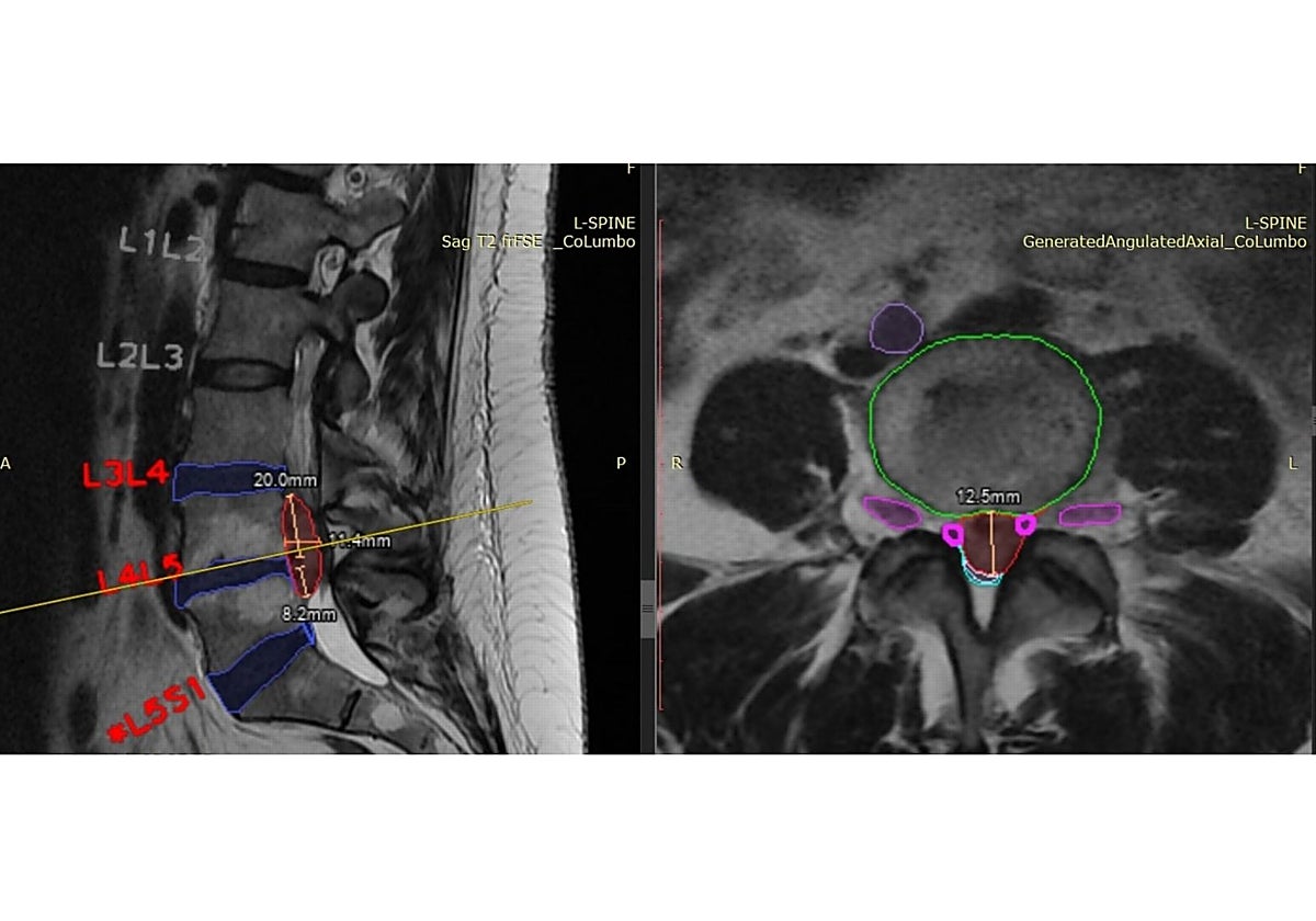 Uso de Inteligencia Artificial para el análisis de una resonancia magnética