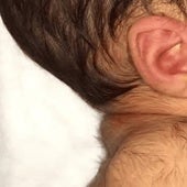 Imagen de un bebé con hípertricosis