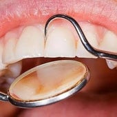 Los expertos confirman que una buena salud bucal es esencial para prevenir el cáncer