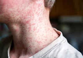 Salud da por cerrado el último brote de sarampión activo y no detecta nuevos casos desde principios de junio