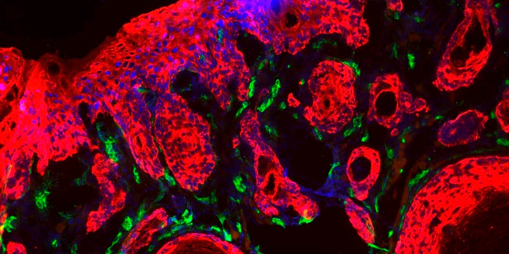 Investigadores diseñan nanopartículas que evolucionan en el entorno tumoral, generando dos terapias diferentes