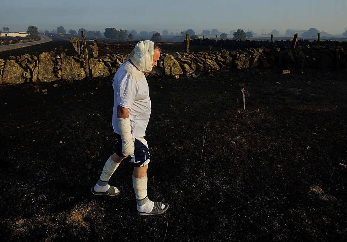 José Manuel Blanco, con quemaduras en varias partes del cuerpo, observa la zona arrasada por el incendio de Cipérez