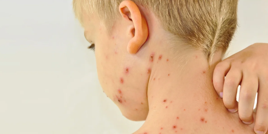 Se elevan a 21 los casos de sarampión detectados en  el brote de La Palma