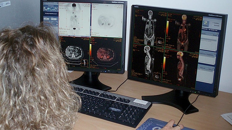 Castilla-La Mancha pondrá en marcha en 2026 el cribado de cáncer de pulmón