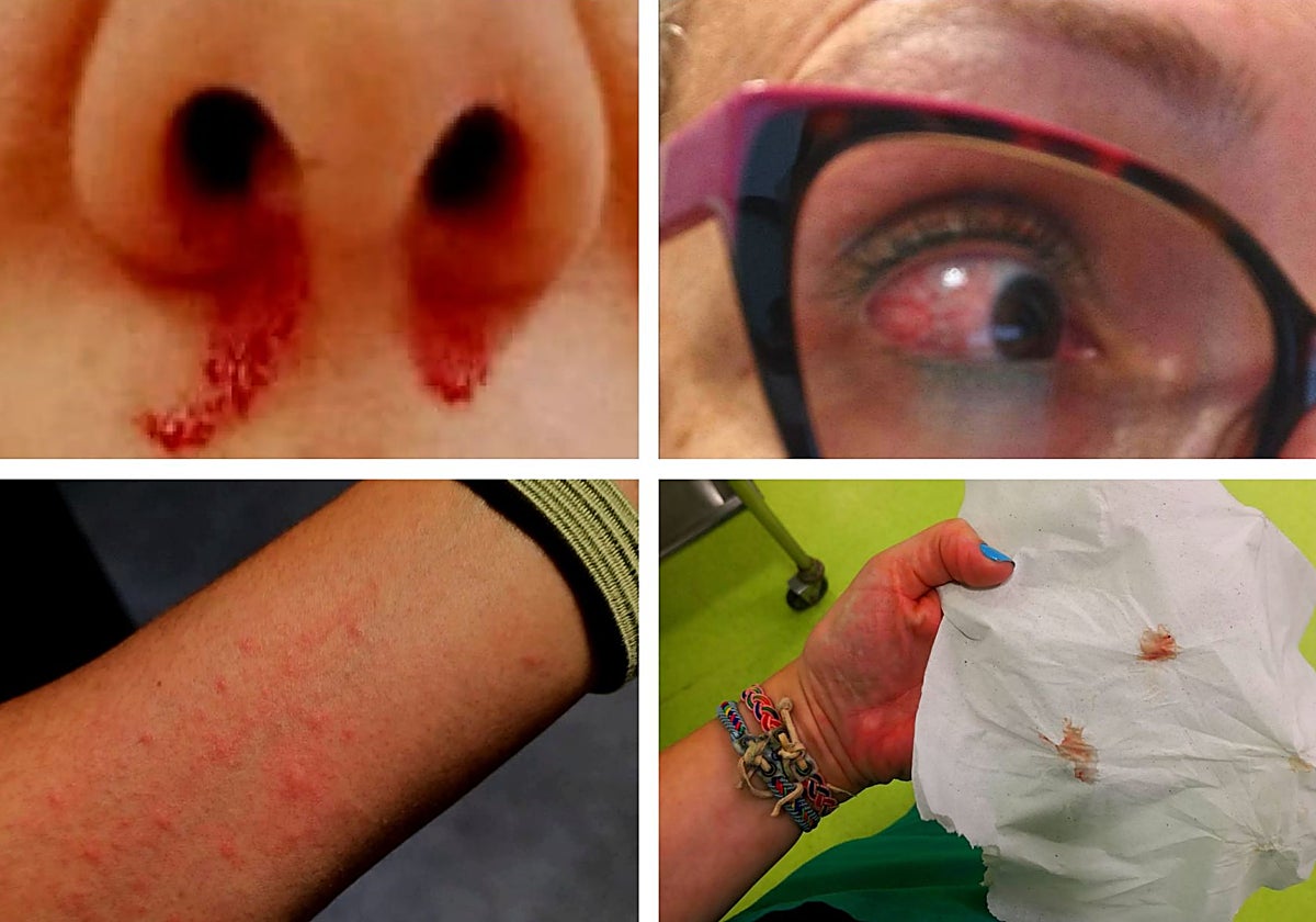 Imágenes tomadas por los afectados: sangrados nasales, irritaciones en los ojos y cutáneas son algunos síntomas