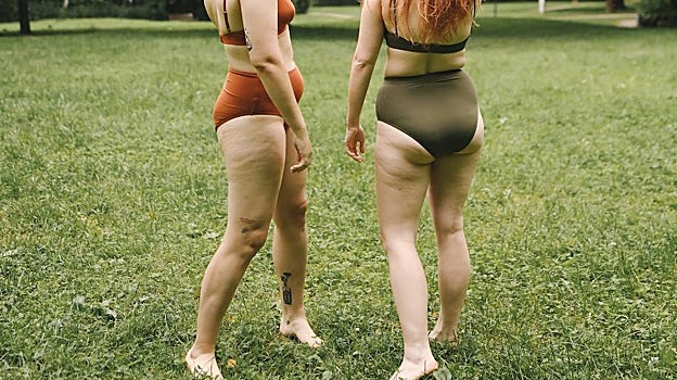 Las celulitis suele aparecer en las piernas, principalmente, en la zona superior, conocida como cartucheras.