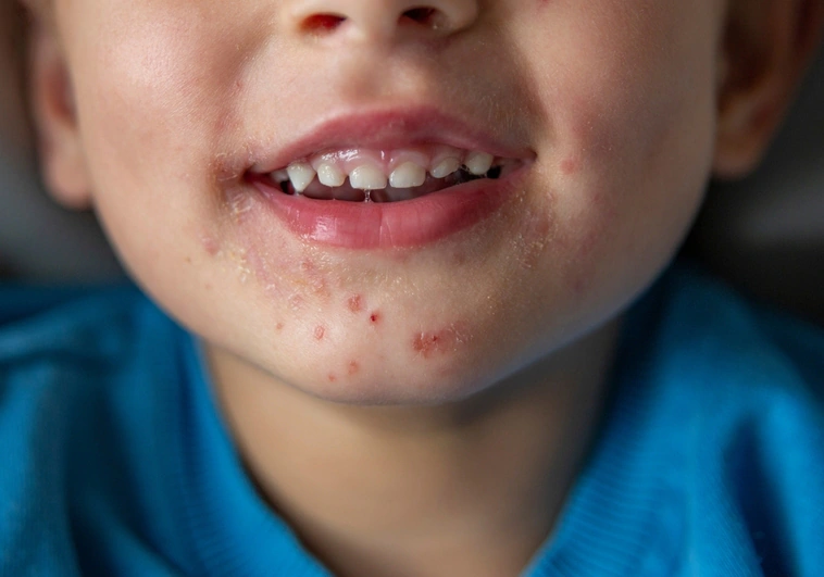La enfermedad boca-mano-pie que crece en la consultas de pediatría