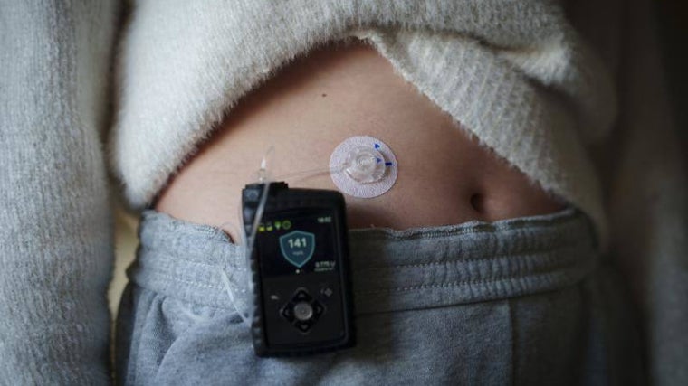 Detalle de la bomba de insulina que lleva Sara y que según esta menor, «le ha mejorado mucho la vida»