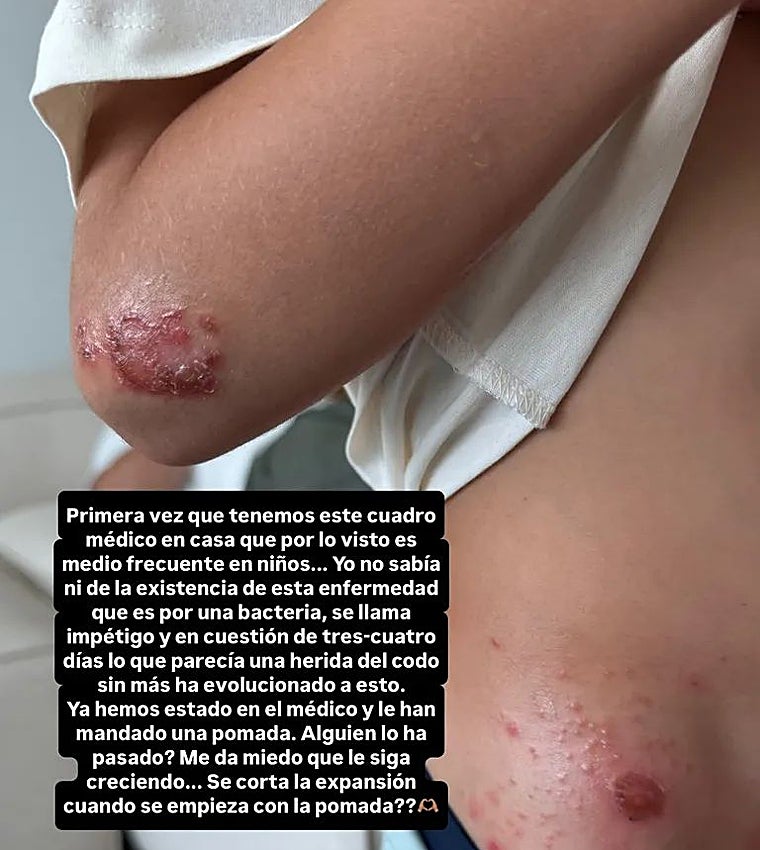 Las heridas del pequeño Jacobo por el impétigo