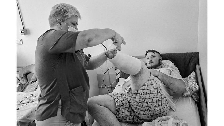 Leópolis, Ucrania - Junio 28, 2023: Andriy (apodo de guerra Sailor) era ingeniero de desminado en la Brigada 150 de las defensas territoriales. Estaban limpiando una zona de bosque en la línea del frente Bajmut y calló en un trampa explosiva rusa que le hizo perder la pierna. Ahora se recupera en el hospital de San Panteleimon en Leópolis