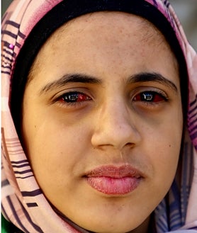 Imagen secundaria 2 - Cientos de camiones cargados con ayuda humanitaria hacen cola para entrar en Gaza por el paso fronterizo de Rafah (imagen superior), lo que Egipto achaca a los controles israelíes. Por este cruce no solo llega la asistencia a los palestinos, sino que también salen los heridos evacuados a hospitales de Egipto y otros países. Estos últimos son trasladados desde el cercano aeropuerto de El Arish (arriba a la izquierda), como Amina, una niña de 13 años que perdió a su padre en un bombardeo israelí y será tratada de la sangre que se le acumula en los ojos en Qatar (arriba a la derecha).  