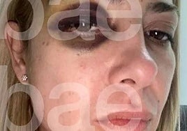 Salen a la luz imágenes de la expareja de Alberto Fernández con marcas de violencia: «Todo el tiempo me golpeas»