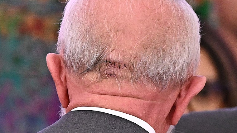 Un detalle de la herida de Lula Da Silva, en una imagen de octubre de 2024