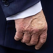 Detectan a Trump hinchazón en las piernas y un moratón en una mano