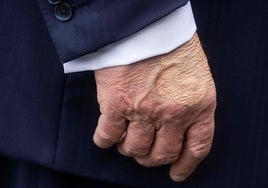 Detectan a Trump hinchazón en las piernas y un moratón en una mano por «estrechar muchas»