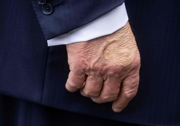 Detectan a Trump hinchazón en las piernas y un moratón en una mano por «estrechar muchas»