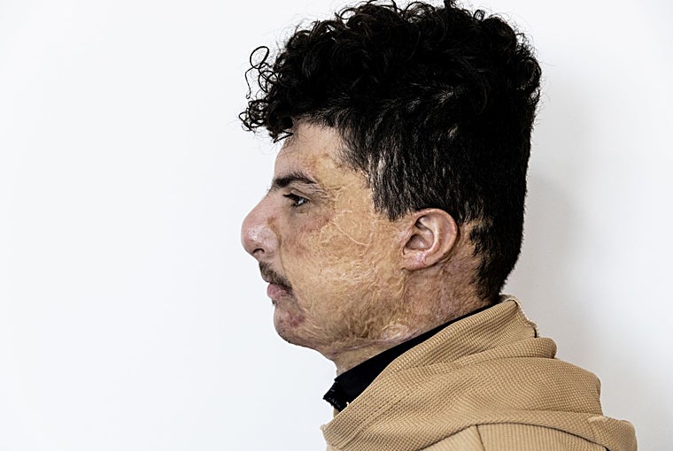Hossam Abdulrahman, paciente iraquí, muestra las secuelas de las quemaduras en su rostro
