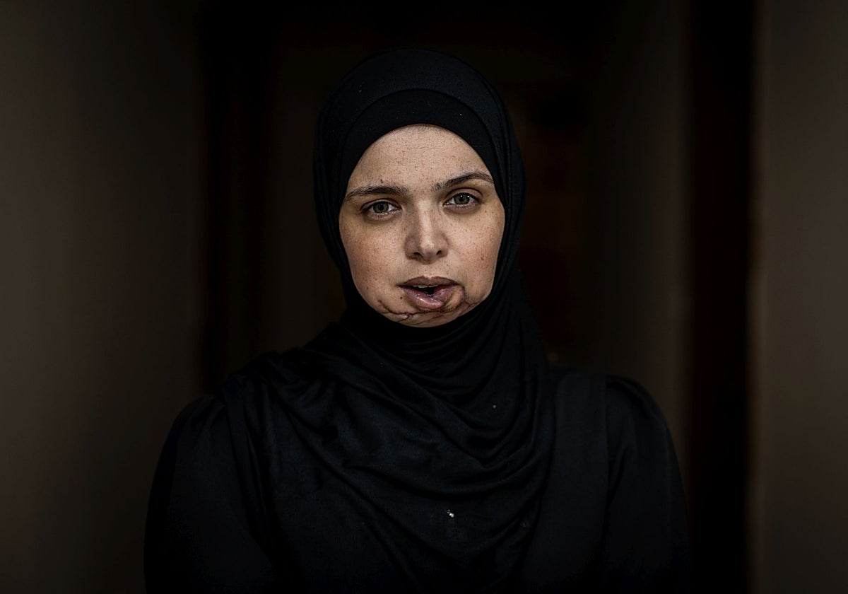 Duha Elsaife muestra sus cicatrices en el rostro tras ser víctima de un bombardeo israelí en Ciudad de Gaza