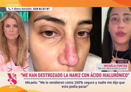 Víctima de los «riesgos» de las «inyecciones de ácido hialurónico»: «¡Me han destrozado la nariz!»