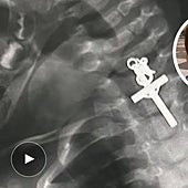 Operada de urgencia una bebé de diez meses que se tragó un crucifijo