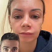 Un técnico de emergencias avisa a los que se aplastan granos en la cara: «Puede quedarse paralizada»