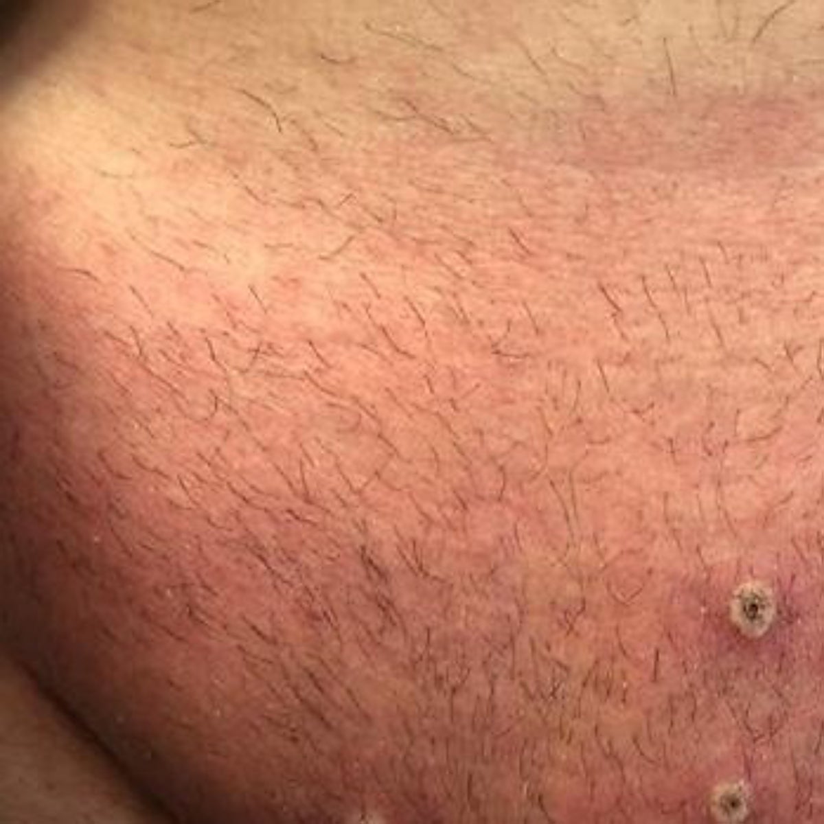 Nuevos síntomas de la viruela del mono: llagas en la boca y el ano