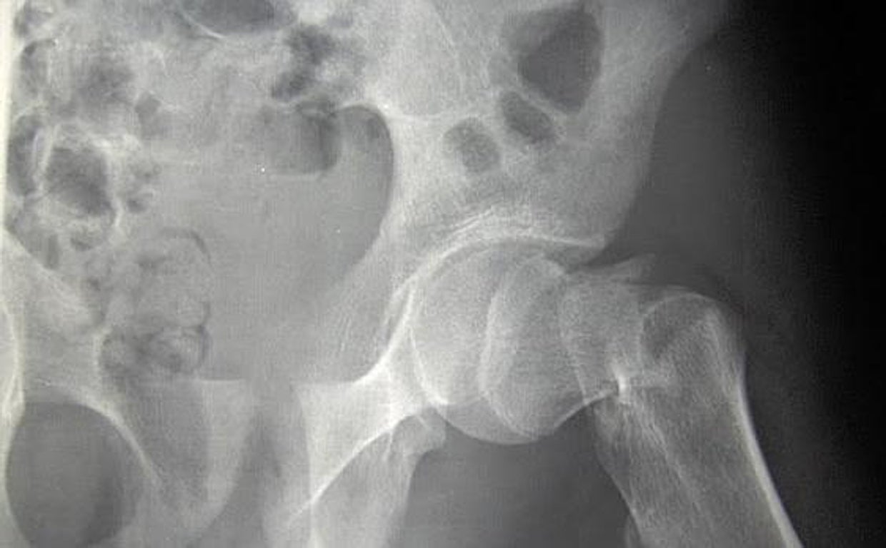 Radiografía de una fractura de cadera