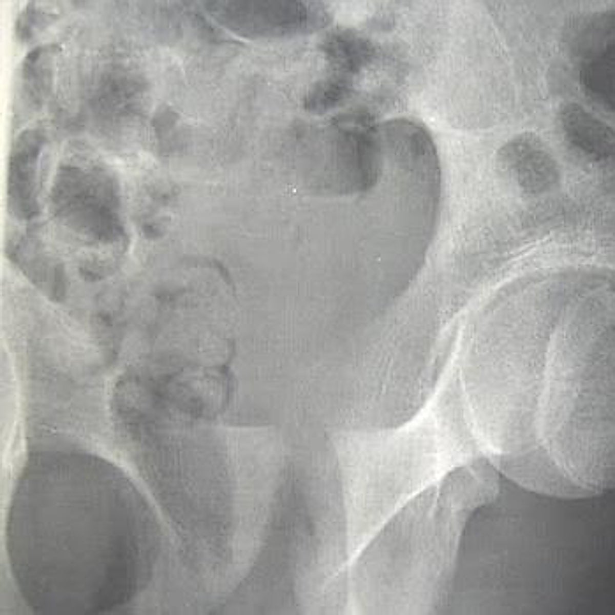 Los suplementos de vitamina D tampoco previenen las fracturas