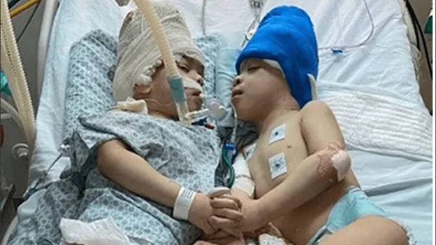 Brazilian conjoined twins joined at the head have been successfully separated