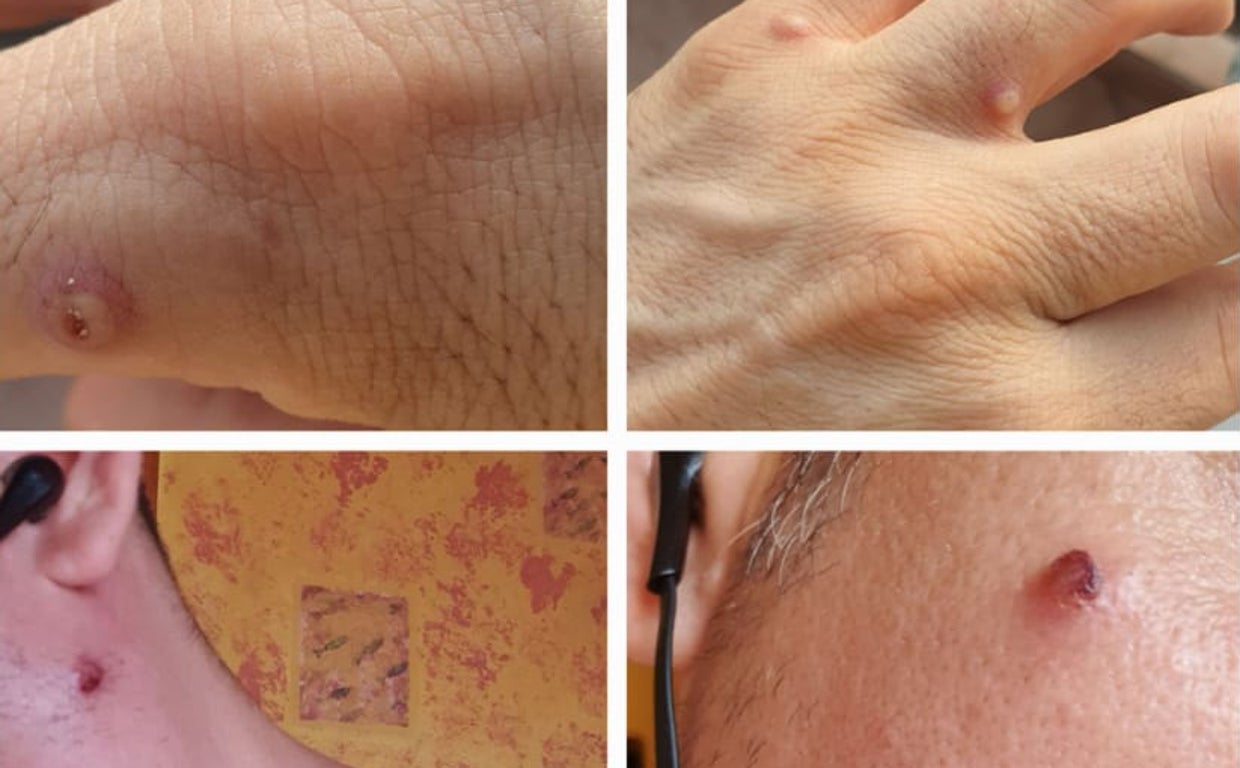 En imagen, varias erupciones en la piel de una persona contagiada con viruela del mono