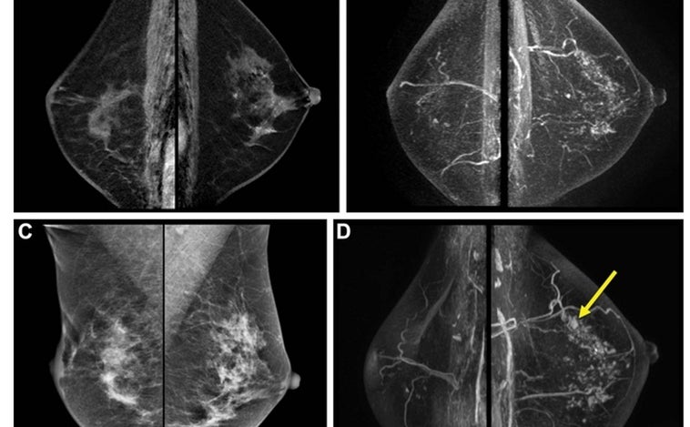 La resonancia magnética revela el riesgo de un segundo cáncer de mama