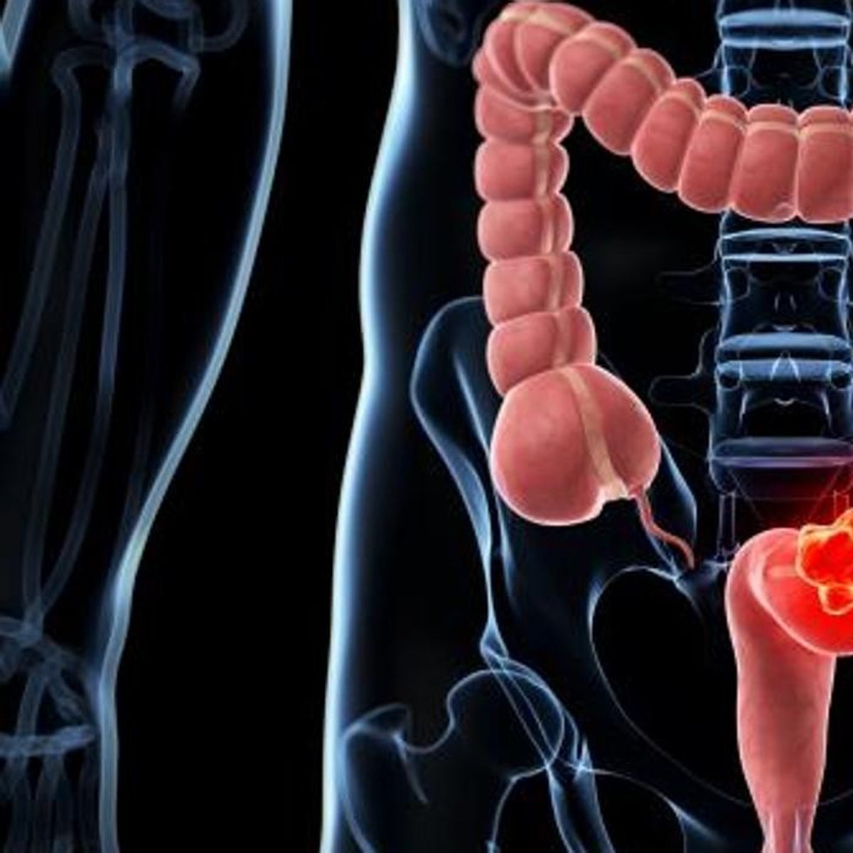 Estos son los síntomas que alertan del cáncer de colon: hazles caso