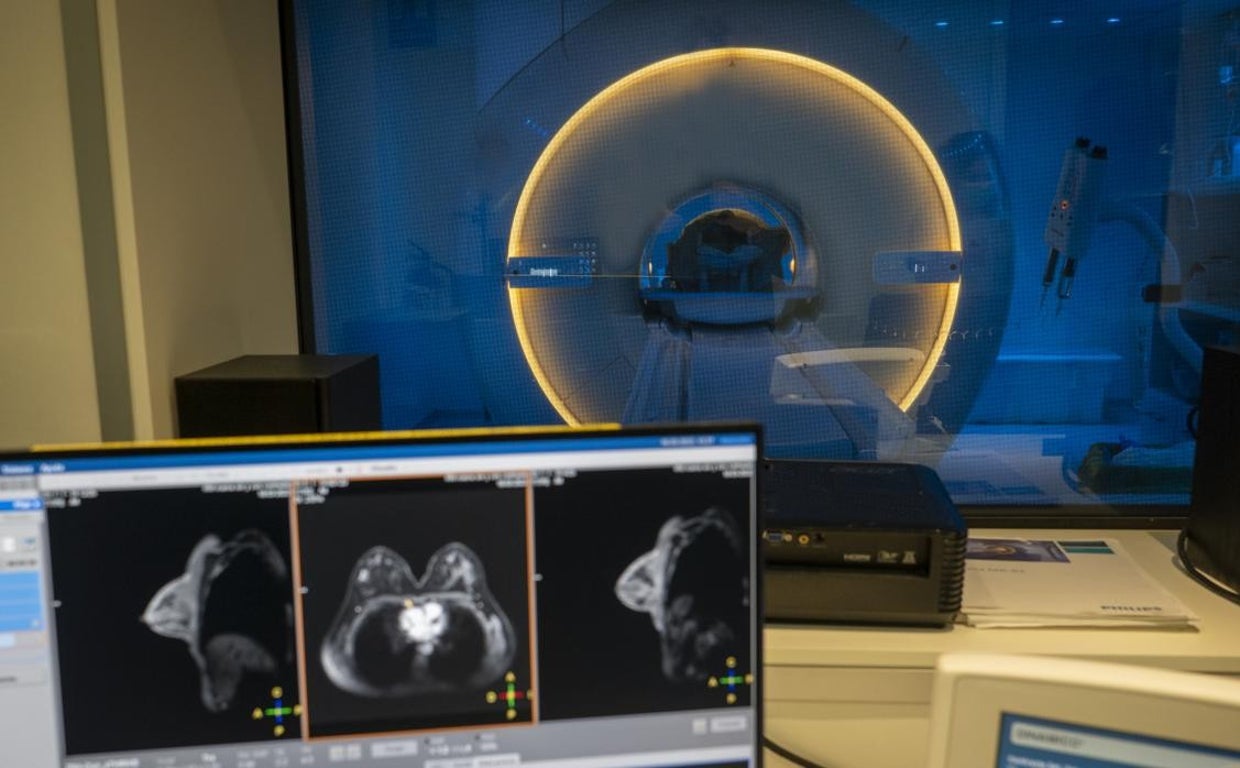 Este marcador evitará la toxicidad cardíaca en la terapia del cáncer de mama