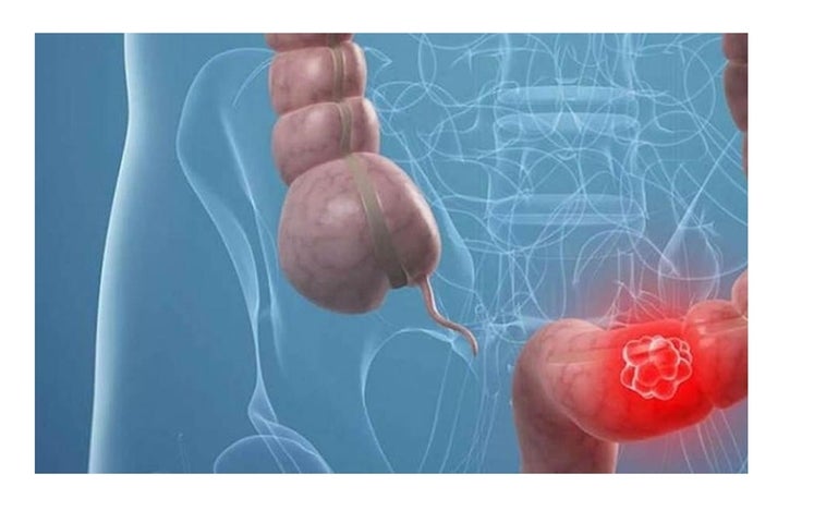 Este gen, y su microambiente, impulsan el cáncer de colon